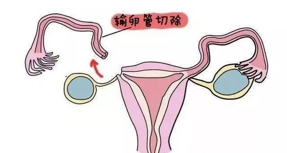 供卵试管婴儿中出现黄体不足该怎么办？如何判断自己是否患有黄体功能不全？